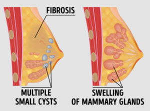 Fibrocystic masses in your breasts